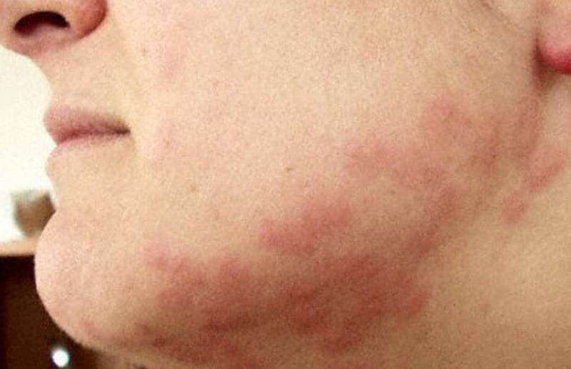 bed bug bite rash on human face
